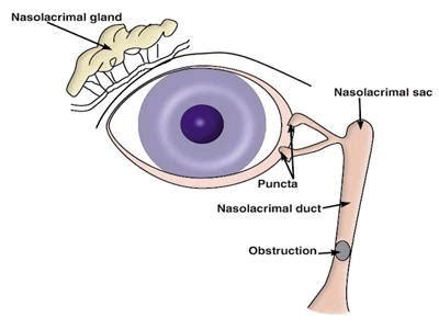 tear duct patency test|Secondary Acquired Nasolacrimal Duct Obstruction .